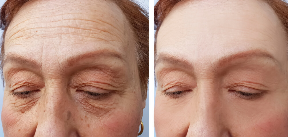 Vitamin c against Skin Photo-Aging